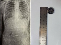 Новороссийские врачи спасли мальчика, проглотившего батарейку 