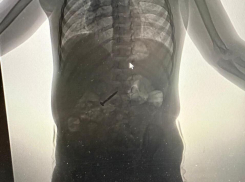 В Новороссийске врачи спасли ребенка от самореза в желудке