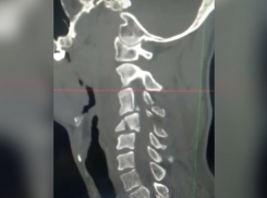 Упал с тарзанки: новороссийские врачи спасли мужчину от паралича 