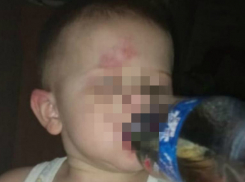 В битве с ливнёвкой малыш из Новороссийска потерпел поражение