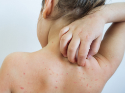 Корь - новая пандемия? Как новороссийцам уберечь себя от болезни 