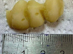 Чего только не случается: новороссиец проглотил зубной протез 