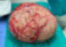 Двухкилограммовую опухоль матки удалили у жительницы Новороссийска 