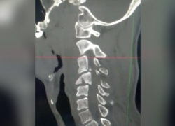 Упал с тарзанки: новороссийские врачи спасли мужчину от паралича 