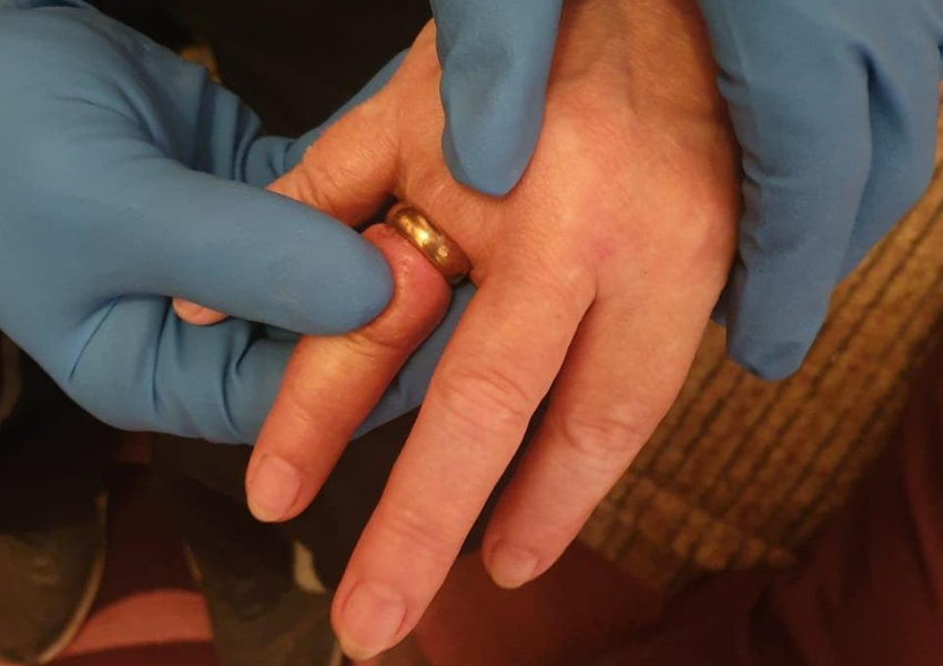 В Новороссийске прошла операция по спасению пальца от обручального кольца